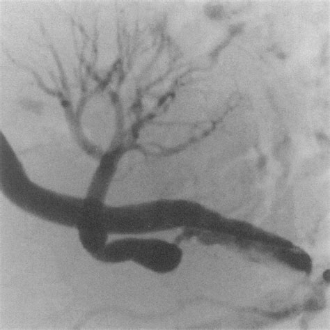 Renal angiogram showing stenosis at the origin of the transplanted... | Download Scientific Diagram