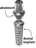 Dental implant abutment