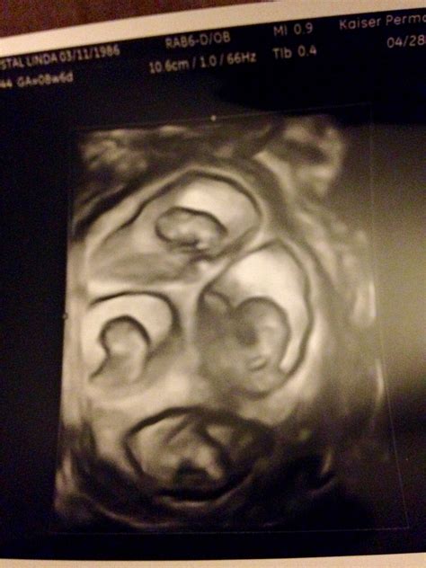 Pregnant With Quadruplets Ultrasound