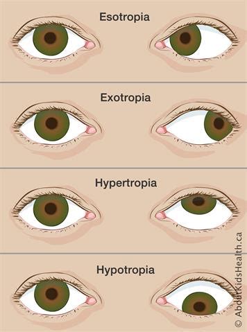 Strabismus