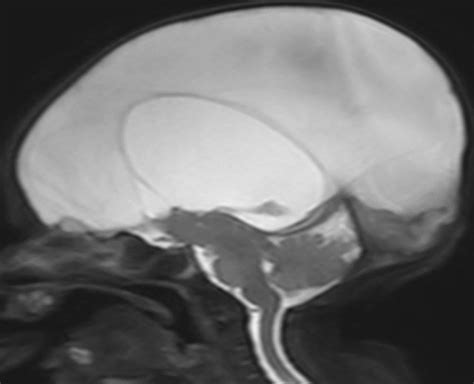 Hydranencephaly • APPLIED RADIOLOGY