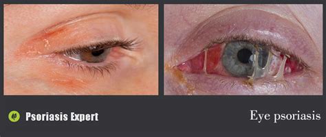 eye psoriasis | Psoriasis expert