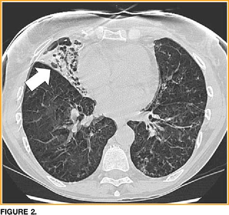 Figure 2 from Lady Windermere Syndrome. | Semantic Scholar