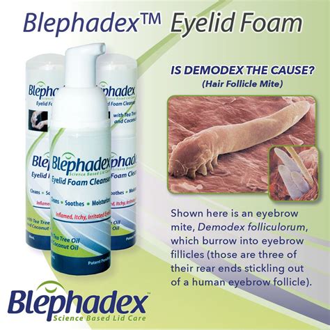 Blepharitis is an eye condition characterized by chronic inflammation of the eyelid. • Redness ...