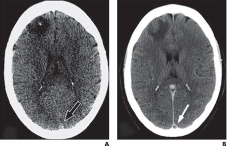 Figure 1 from Dural sinus thrombosis: sources of error in image ...