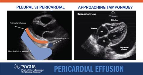 Pericardial Effusion | POCUS Resources & Case Studies | POCUS.org