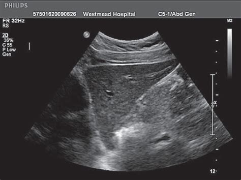 The liver: how we do it - Macnaught - 2009 - Australasian Journal of Ultrasound in Medicine ...