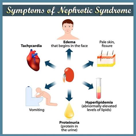 Nephrotic Syndrome | Nephrotic syndrome, Syndrome, Medical conditions