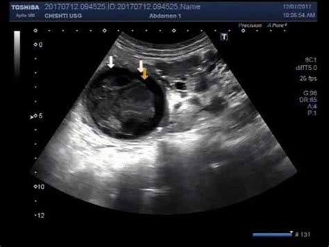 Renal Cyst Ultrasound