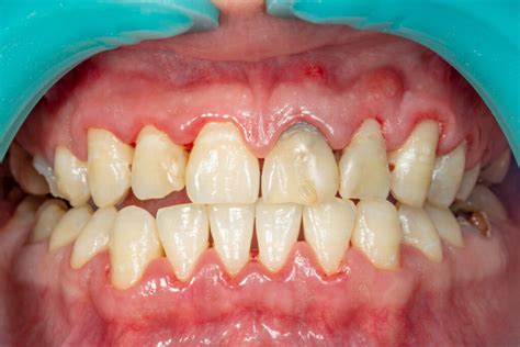 The Different Stages of Periodontal Disease - Sumner, WA