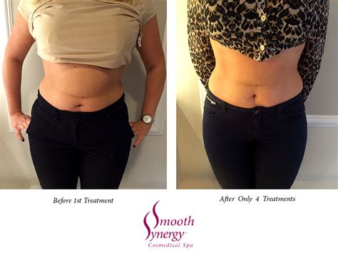 Ultrasonic Lipo Cavitation Treatments - Smooth Synergy Medical Spa ...