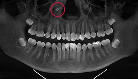 Supernumerary Teeth In Nose