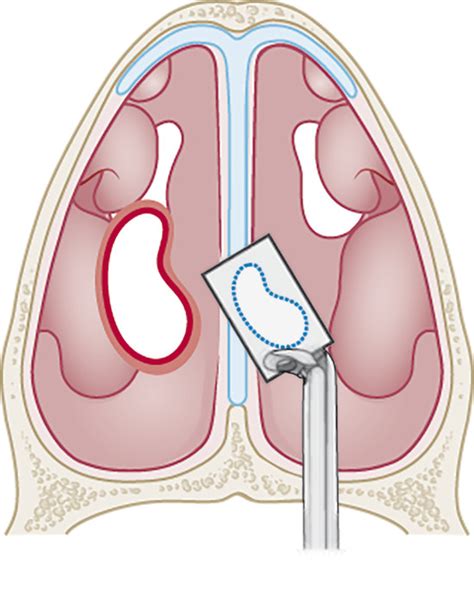 8 Nasal Perforation and Septal Prosthesis | Plastic Surgery Key