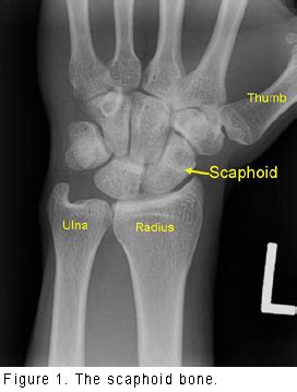 Scaphoid Fracture Cast Time