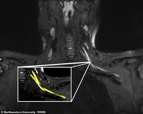 Detailed MRI scans can identify the source of debilitating nerve pain in 'Long Covid' patients ...