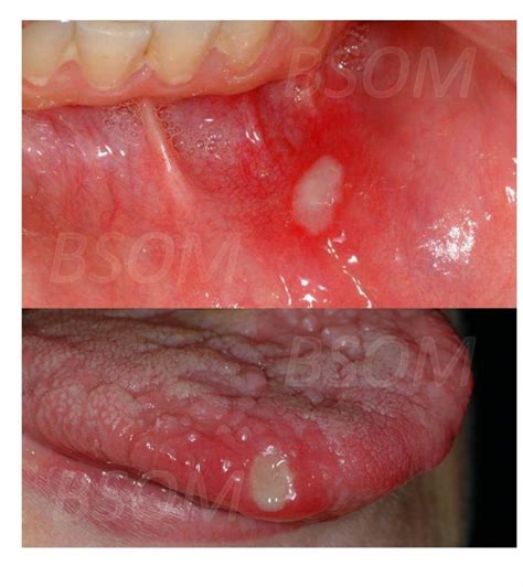 Recurrent Mouth Ulcers - British & Irish Society for Oral Medicine