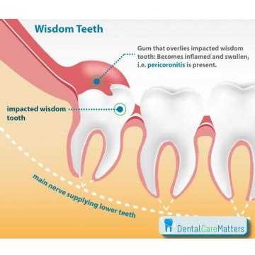 Wisdom Teeth Complications Headington | Extractions Oxford | Cowley