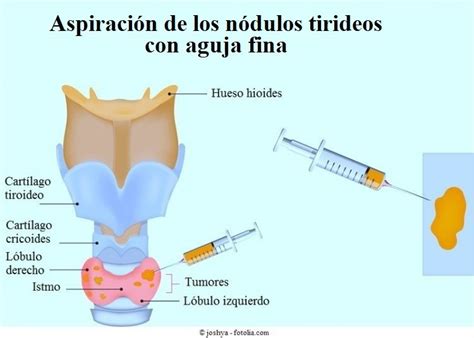 Nódulos tiroideos, síntomas, benignos, malignos, tamaño, causas y tratamiento