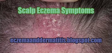 Scalp Eczema Symptoms - Eczema and Dermatitis