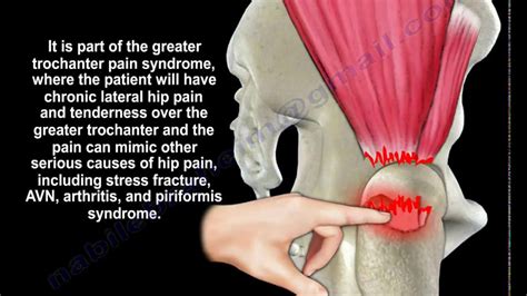 Gluteus Medius Tendon Tear - Everything You Need To Know - Dr. Nabil ...