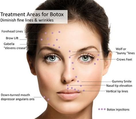 Botox | Burlington, Woburn | DermPhysicians of New England