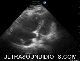 Pulmonary Embolism — Ultrasound Idiots