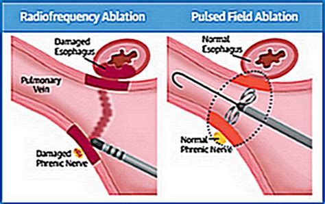 2020 AF Symposium: Pulsed Field Ablation vs RF Ablation: a Study in ...