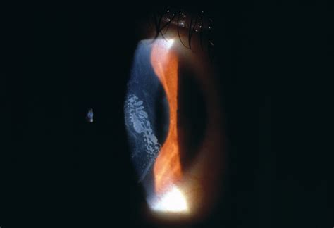 Treatment of Epithelial Ingrowth After Laser In Situ KeratomileusisWith Mechanical Debridement ...