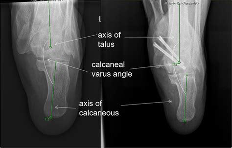 Calcaneal varus angle: the intersection angle between the calcaneus and... | Download Scientific ...