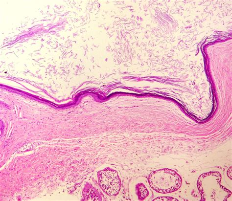 Epidermoid Cyst Histology