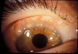 EyeRounds.org: Vernal Keratoconjunctivitis: 8 year-old asthmatic male ...