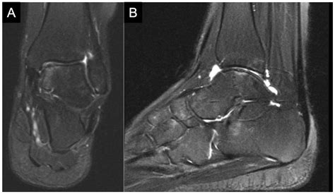 Talus Fracture Mri