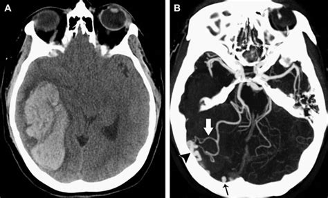 Advanced CT Imaging in the Evaluation of Hemorrhagic Stroke | Radiology Key