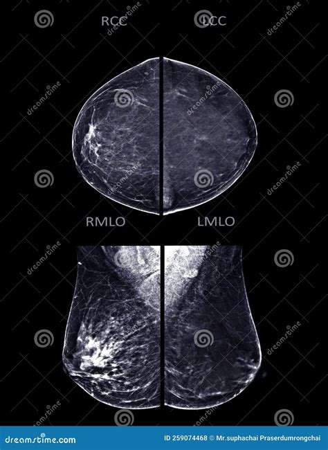 X-ray Digital Mammogram Or Mammography Of Both Side Breast Standard ...