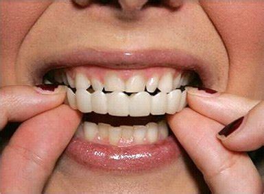 snap on teeth 2 - Dentalopolis