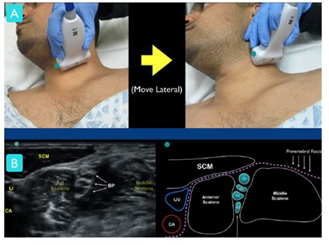 Ultrasound-Guided Interscalene Brachial Plexus Nerve Block – Core EM