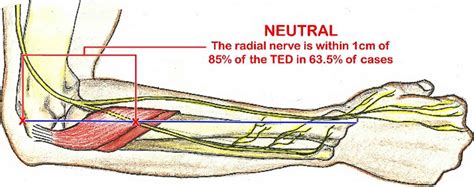 Radial tunnel syndrome causes, symptoms, diagnosis & treatment