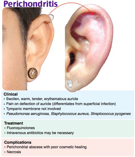 Perichondritis is an infection of the... - Dr. David Lalezari