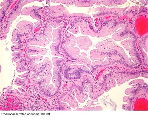 Pathology Outlines - Traditional serrated adenoma