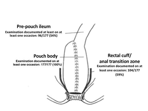 Current Practices in Ileal Pouch Surveillance for Patients With Ulcerative Colitis: A ...