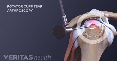 Rotator Cuff Tear Surgery