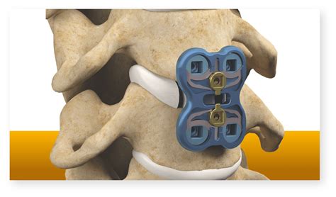 Anterior cervical discectomy and fusion | Stryker | Stryker