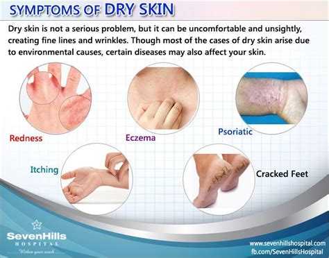 SYMPTOMS OF DRY SKIN #DRY_SKIN #SYMPTOMS_DRY_SKIN | Dry skin symptoms ...