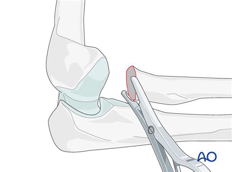 Radial head excision for Radius, partial articular