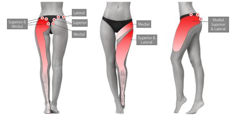 Cluneal Nerve Trigger Point Symptom Distribution. | Download Scientific ...