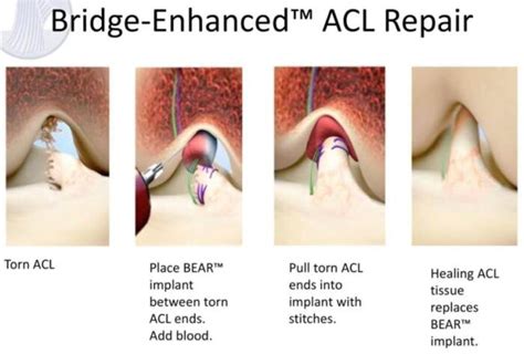 BEAR trials ACL repair — Ryan Cartier