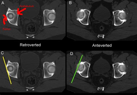 Is Acetabulum Retroversion Caused by Pelvis Dysfunction? | COR