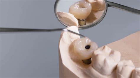 Addressing Risks of Implant Complications - Decisions in Dentistry