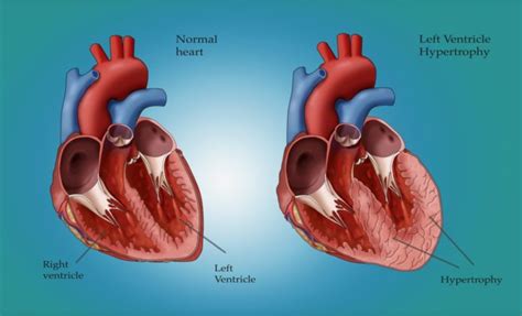 Left ventricular hypertrophy (LVH), also known as an enlarged heart, is associated with a nearly ...