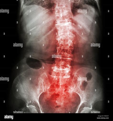 Spondylosis and Scoliosis ( film x-ray lumbar - sacrum spine show ...